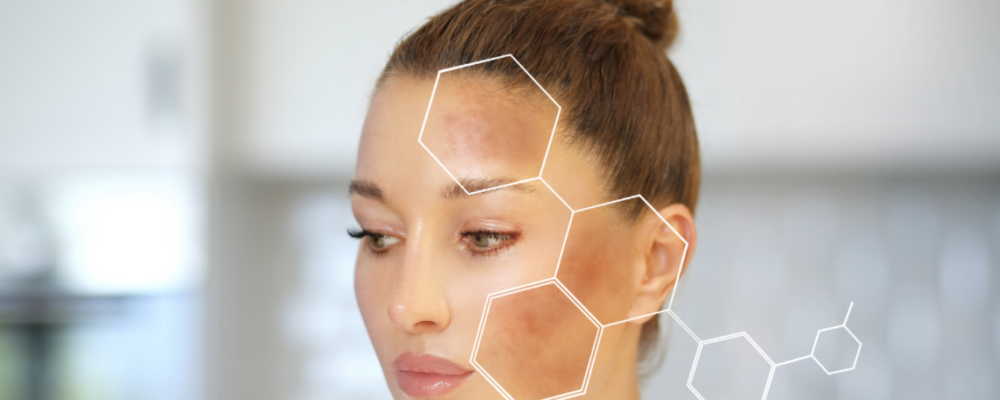 Melasma
